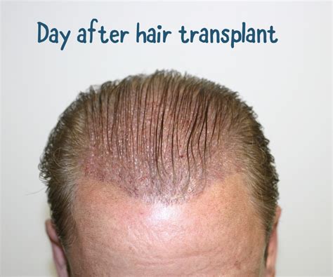 Important Steps to Follow After a Hair Transplant