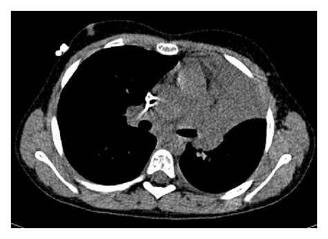 CT scan images of the chest performed on day 9 after transplant. (a ...