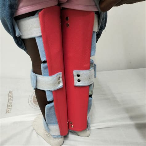 Genu Varus & Valgus (AFKOs) | Bio Orthotics and Prosthetics