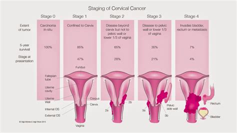 Cervical Cancer