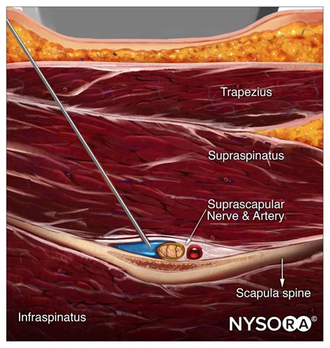 Ultrasound Pain Block Tip of the Week: Suprascapular Nerve Block - NYSORA