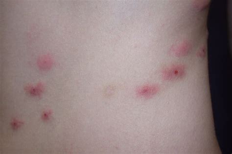 Bedbug Bites vs. Fleabites: Which Is It?