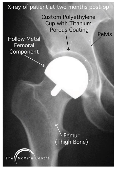 Custom Polyethylene Hip Resurfacing (PHR)