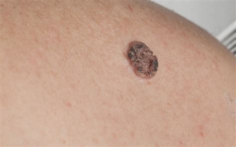 Squamous Cell Carcinoma - The Skin Docs