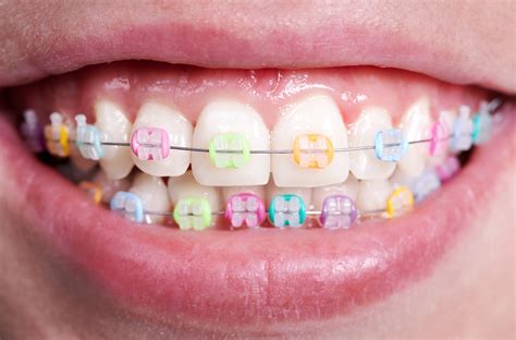 What Colors Rings For Braces Should I Get? | Color My Braces