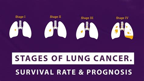 Stages Of Lung Cancer – Survival Rate And Prognosis - Macs Clinic