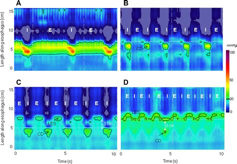 High-Resolution Manometry: An Atlas of Esophageal Motility Disorders and Findings of GERD Using ...