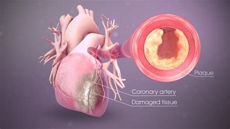 Myocardial Infarction (Heart Attack): Symptoms, Causes, and Treatment