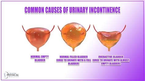 Explore the Symptom, Causes, and Treatments of Urinary Incontinence - Oklahoma Physical Therapy