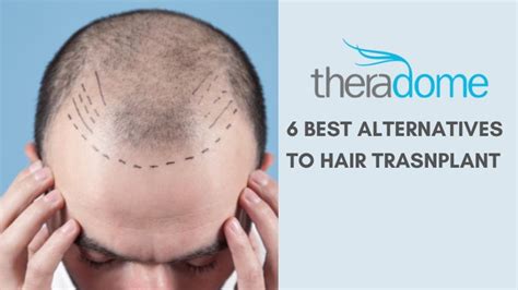 6 Best Alternatives to Hair Transplant Surgery For Hair Growth – Theradome