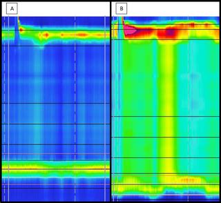 Protocol for an international multicenter randomized controlled trial assessing treatment ...