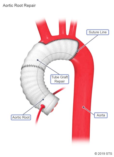 Thoracic Aortic Aneurysm - Newport Cardiac & Thoracic Surgery