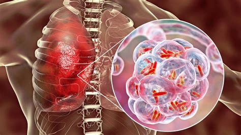 Recursos para el control de Tuberculosis