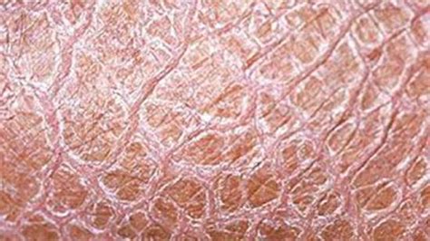 RARE SKIN CONDITION OR EXTREMELY DRY SKIN