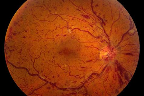 Vascular Occlusive Diseases of the Retina | Retina Consultants of Minnesotra Blog