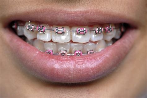 Coloured Braces | Dr. Aly Kanani | BC Orthodontist