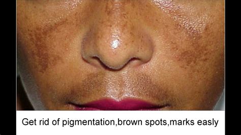 How To Prevent Hyperpigmentation After Popping A Pimple | Justinboey