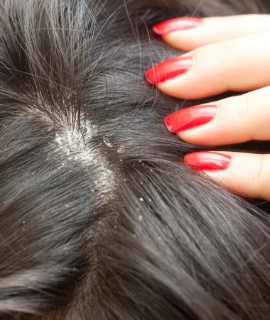 Home Remedies for Dandruff - Health BeatHealth Beat