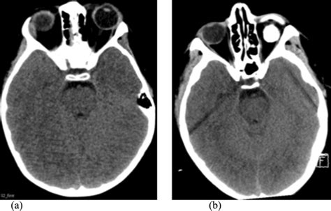 Representative CT images of basal cistern appearance. Patient with a ...