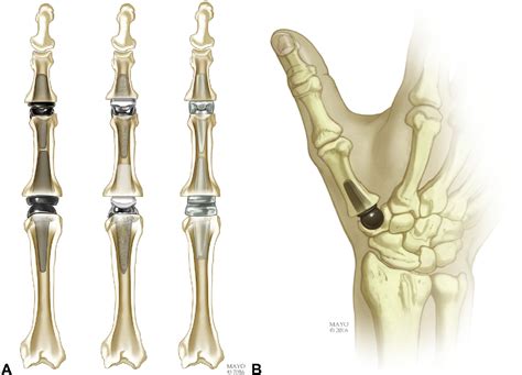 Figure 6 from Implant Arthroplasty for Proximal Interphalangeal ...