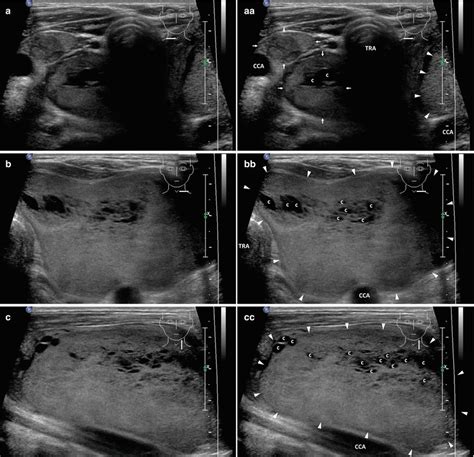 Thyroid Goiter Ultrasound