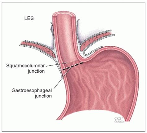 Esophageal testing | Abdominal Key