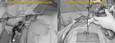 Endoscopic Spinal Procedure | Synergy Spine Center