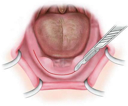 Tori Dental (torus mandibularis) Causes, Removal Surgery, Cost ...