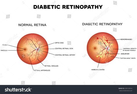 Diabetic retinopathy and normal eye retina. | Eye retina, Diabetic retinopathy, Diabetes