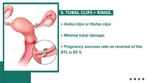 Tubal Reversal