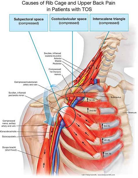 Frontiers | Diagnostic and Therapeutic Management of the Thoracic Outlet Syndrome. Review of the ...