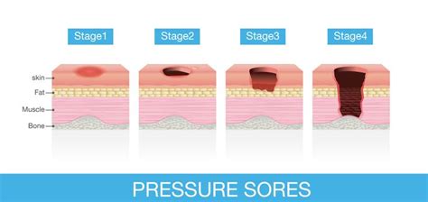 Pressure Ulcer Grades | Pressure ulcer, Soreness, Ulcers