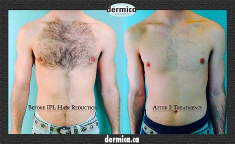 Mens Laser Hair Removal Edmonton | PHOTOTHERAPY