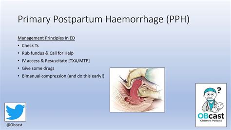 Postpartum Hemorrhage Management