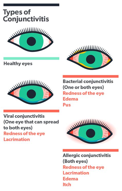 Allergic Conjunctivitis - Cohen Laser & Vision Center