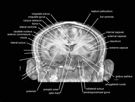 Coronal level 1680 as MRI