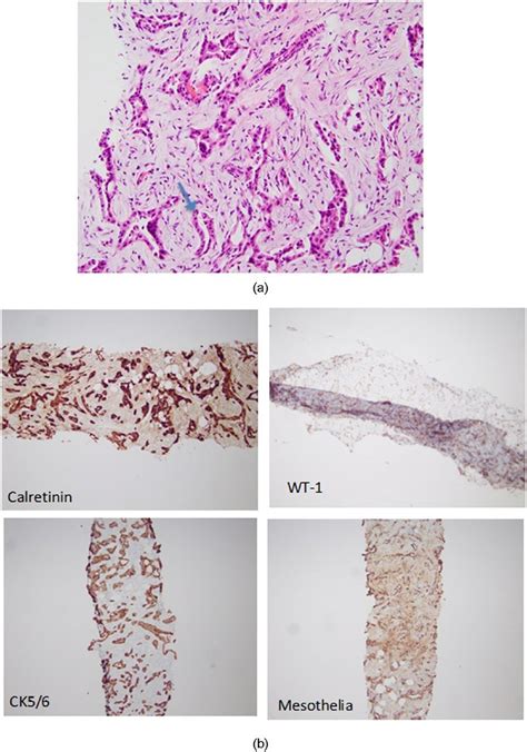 (a) Omental biopsy showing malignant mesothelial cells with... | Download Scientific Diagram