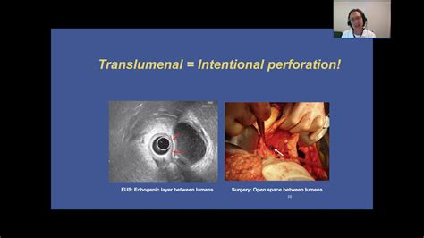 AXIOS stent: The idea, the development, and future directions - YouTube