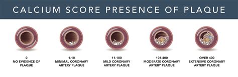 Cardiac Calcium Score Chart