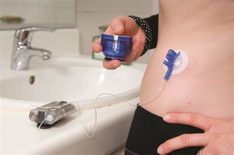 Insulin pumps lead to better clinical outcomes compared with injection - The Pharmaceutical Journal