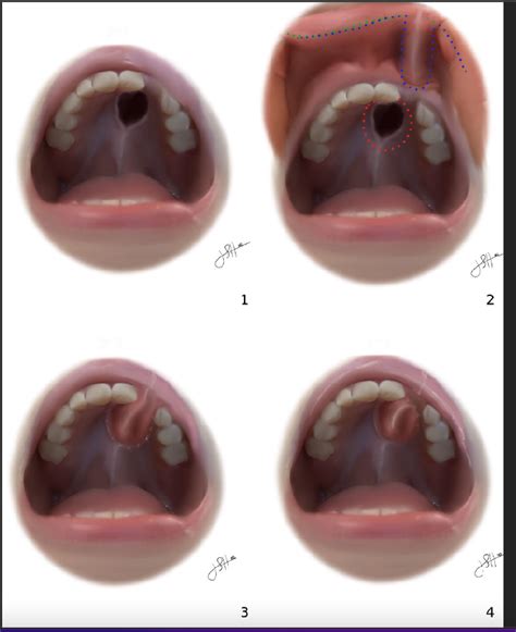 Utilization of the Labial Flap in Anterior Palatal Fistula Repair