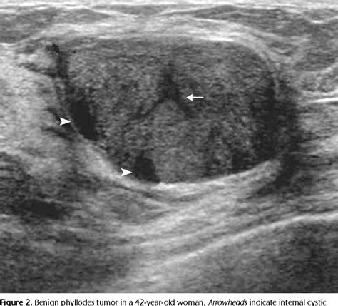 Figure 2 from Fibroadenoma versus phyllodes tumor: distinguishing factors in patients diagnosed ...