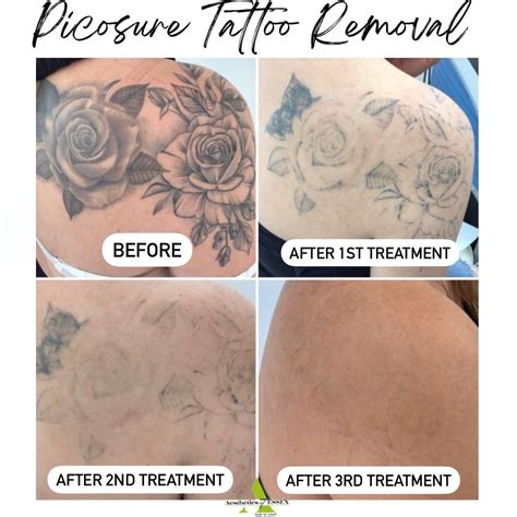 Picosure Tattoo Removal - Aesthetics of Essex