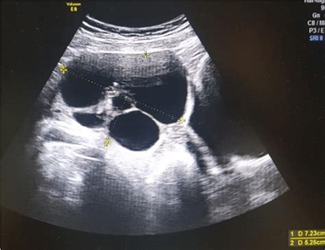 Cysts In Uterus Ultrasound