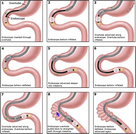 Enteroscopy - Gastrointestinal Endoscopy