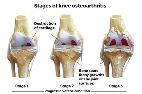 Knee Osteoarthritis or Injury Joint Restoration - Vista Wellness MD ...