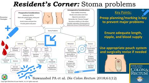 Prevention and Management of Colostomy Complications: Retrac ...