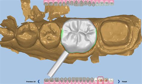 CAD-CAM PFM Dental Crown And Bridge ~ Dr. Bharat Katarmal Dental & Implant Clinic