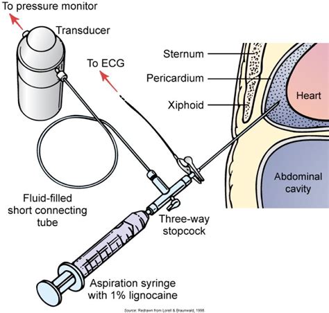 Pericardiocentesis performed under sterile conditions in conjunction with electrocardiogram and ...