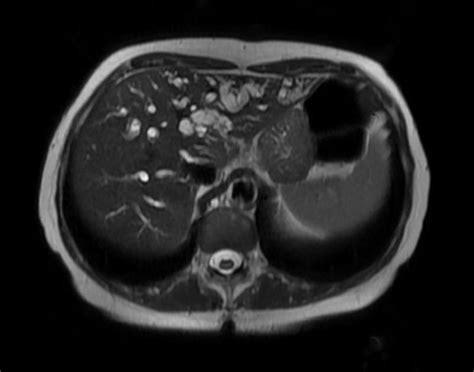 Gallbladder cancer MRI - wikidoc
